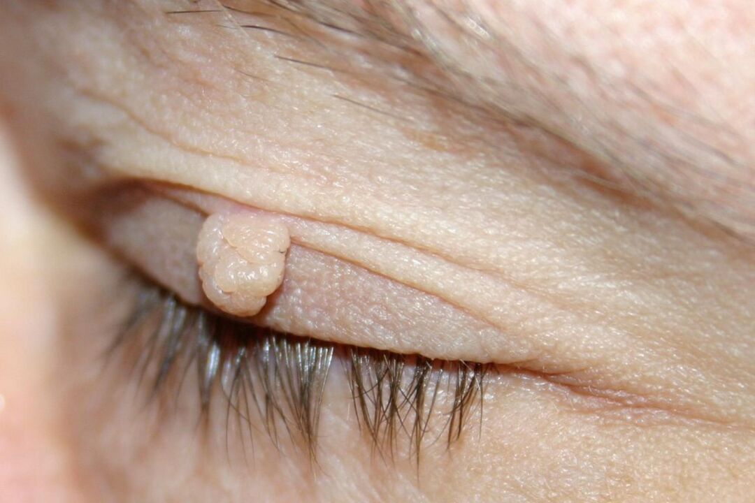 papilomos simptomai ant akies voko